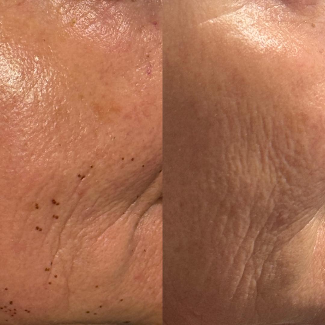 Plasma fibroblast before and after Perth - non-surgical skin tightening results