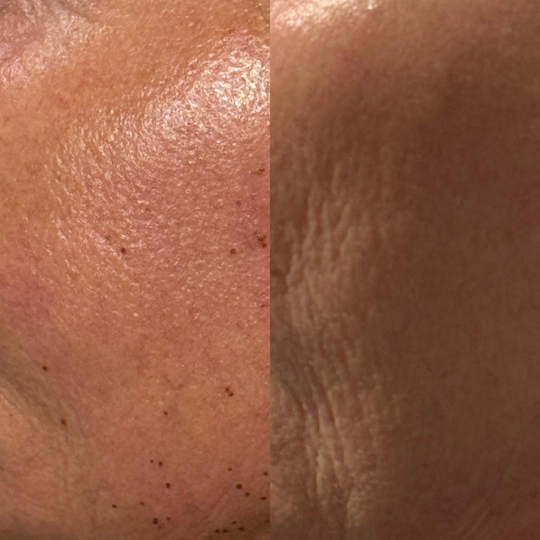 Plasma fibroblast before and after Perth - skin rejuvenation and collagen results