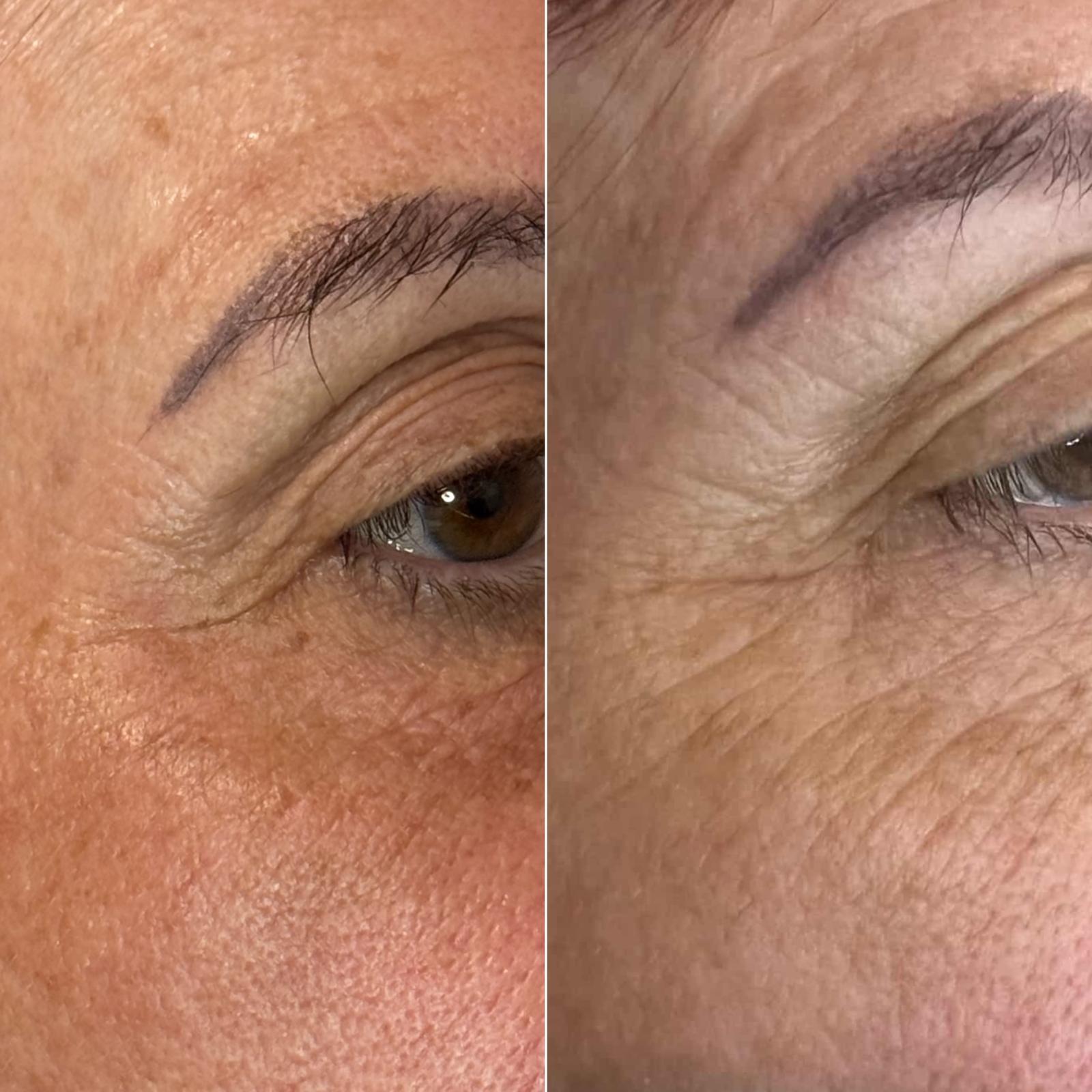 Plasma fibroblast eyelid lifting before and after Perth - hooded eye treatment results