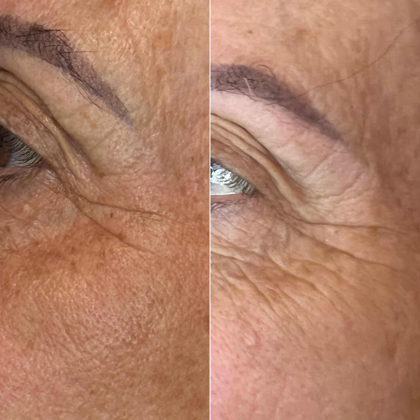 Plasma fibroblast wrinkle reduction before and after Perth - crow's feet treatment results