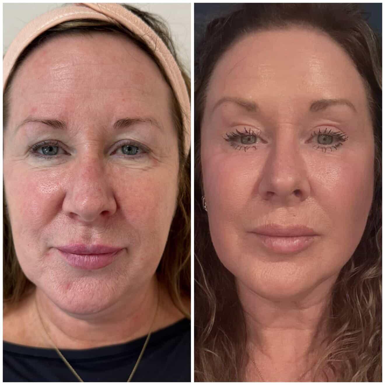 Plasma fibroblast before and after results Perth - face skin tightening treatment